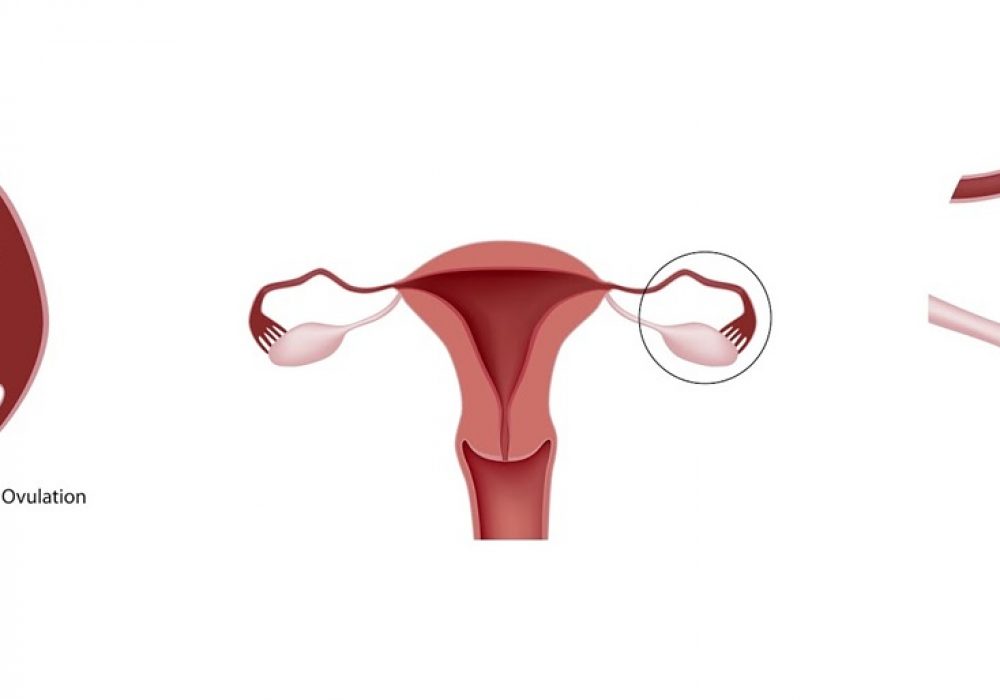 polycystic-ovarian-syndrome